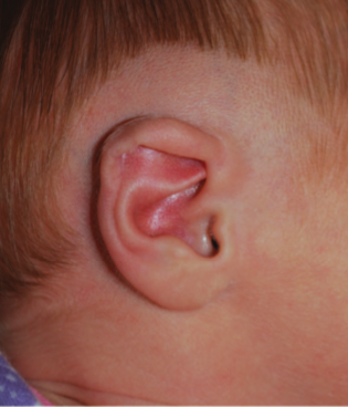 earwell oorcorrectie