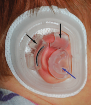 oorcorrectie baby stap 2